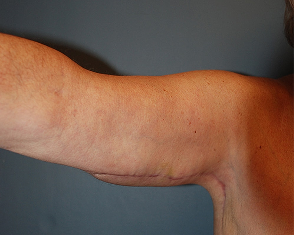 Brachioplasty Patrick Felice Before & After