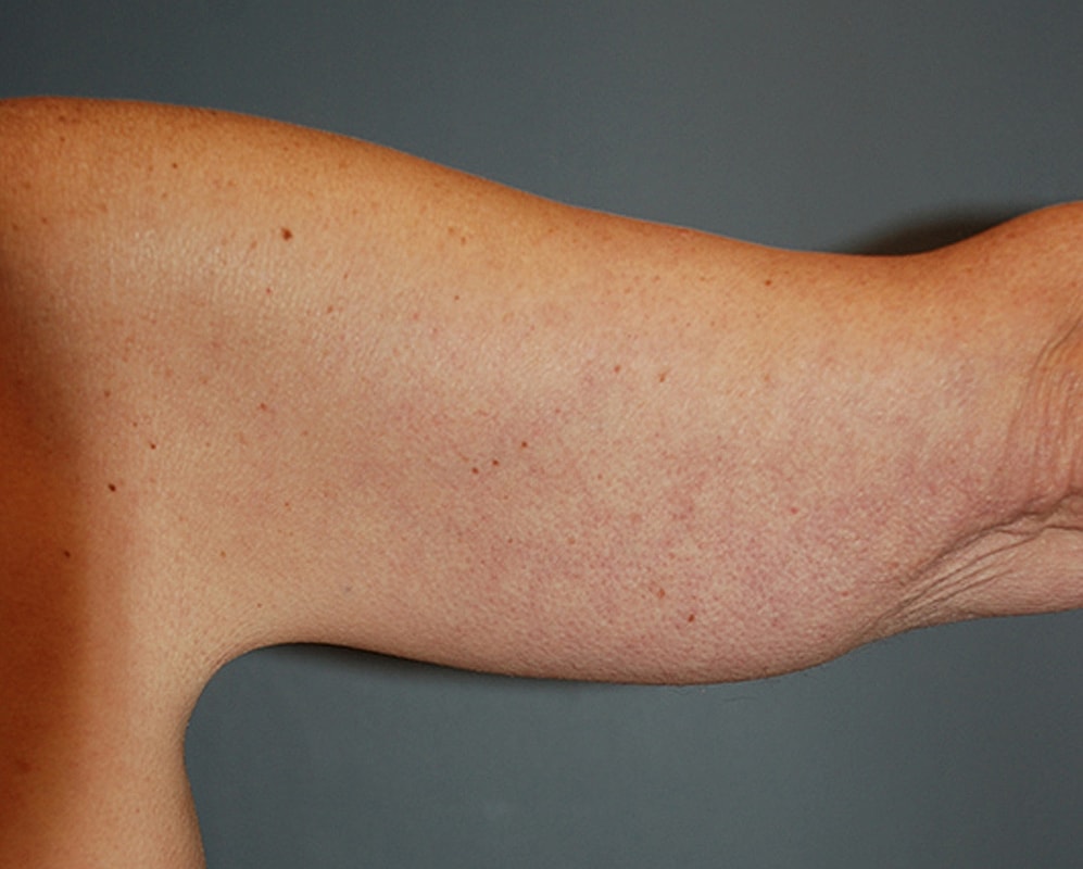 Brachioplasty Patrick Felice Before & After
