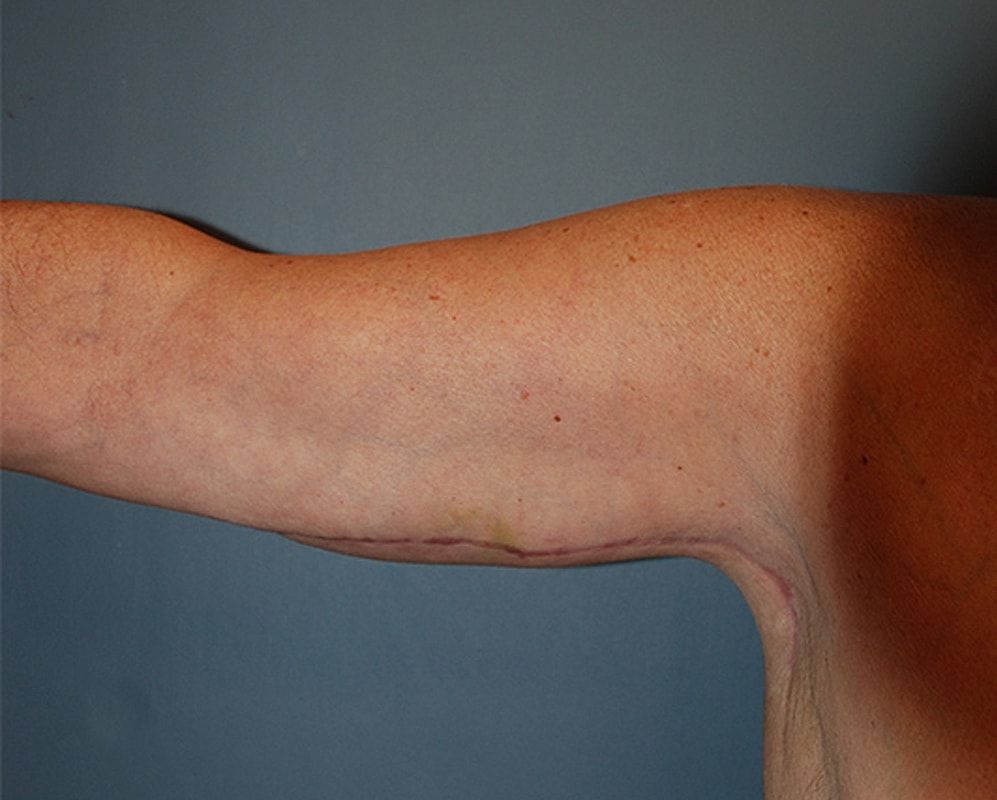 Brachioplasty Patrick Felice Before & After