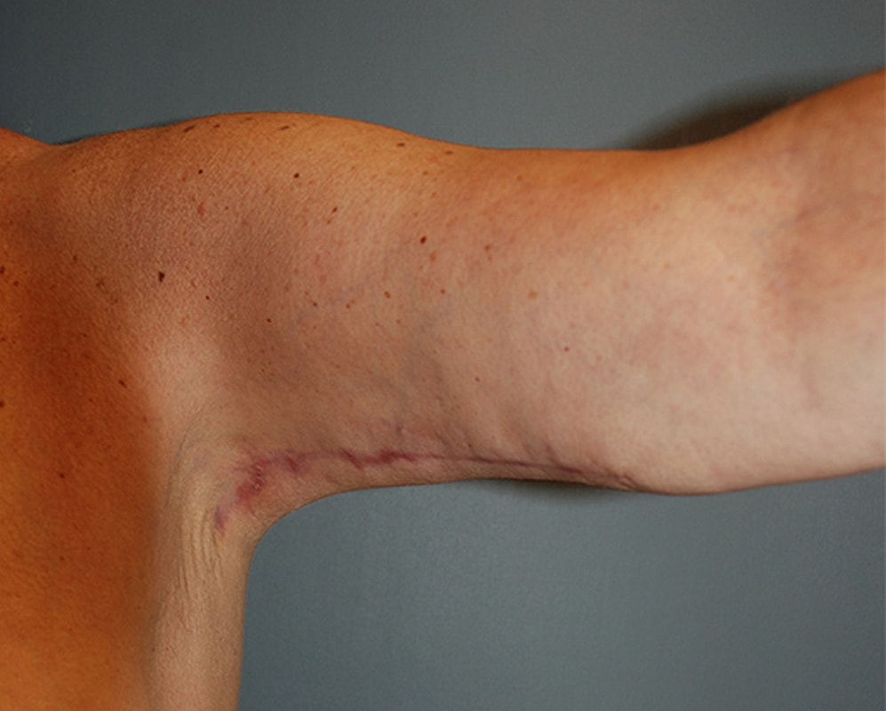 Brachioplasty Patrick Felice Before & After