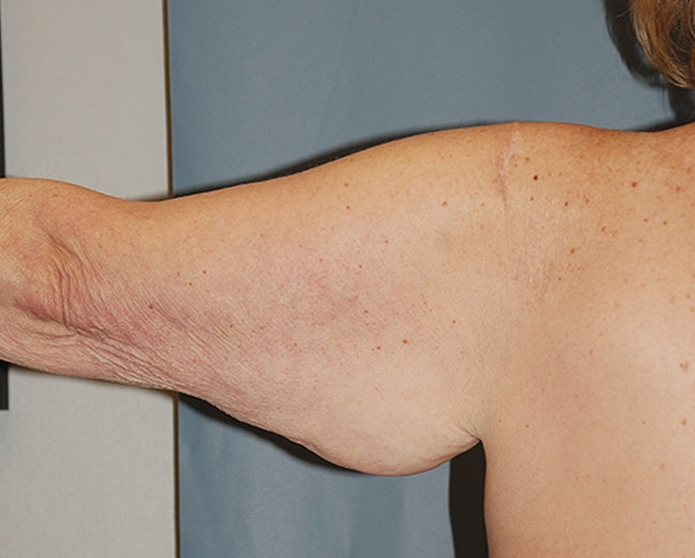 Brachioplasty Patrick Felice Before & After