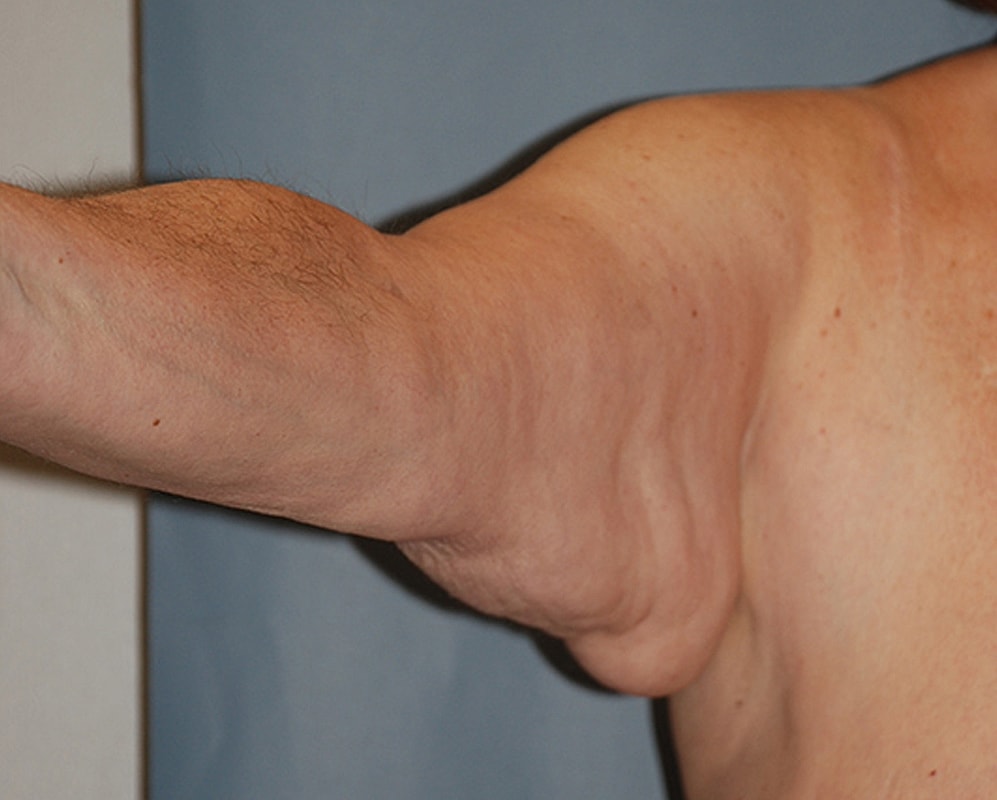 Brachioplasty Patrick Felice Before & After