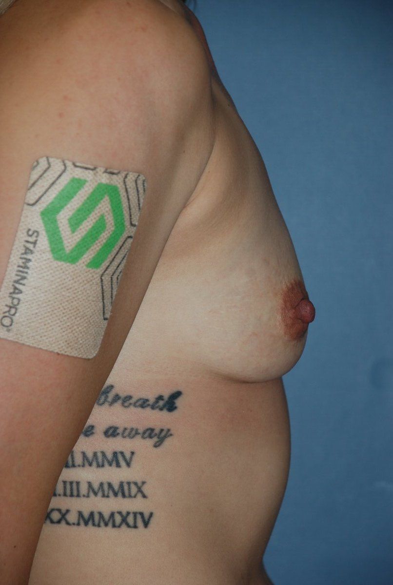 Breast Augmentation Patrick Felice Before & After