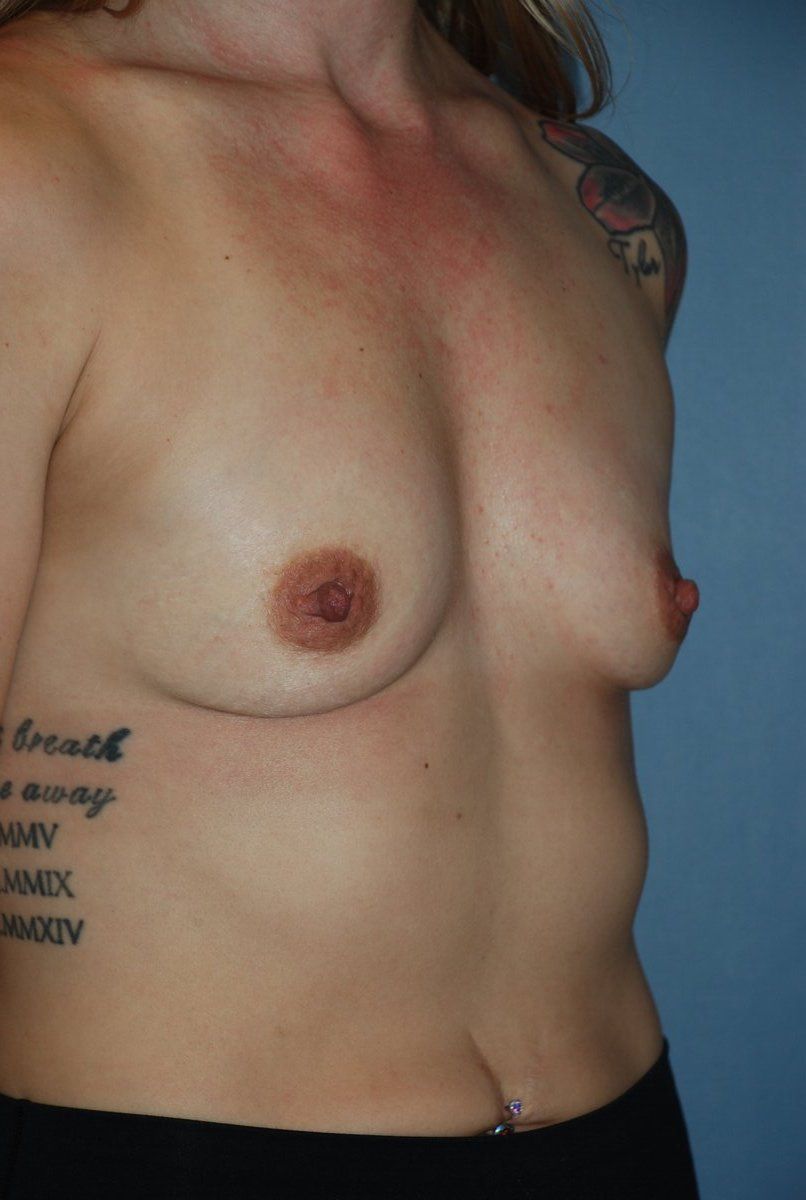 Breast Augmentation Patrick Felice Before & After
