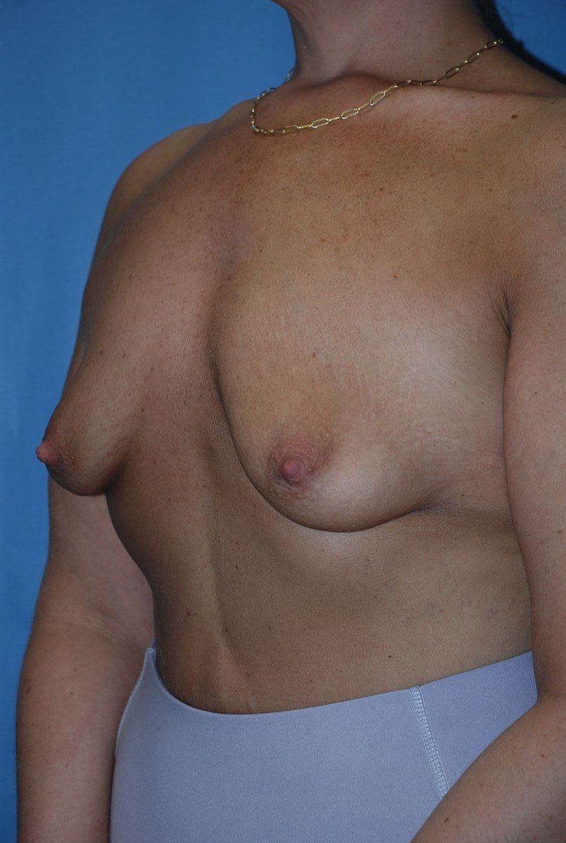 Breast Augmentation Patrick Felice Before & After