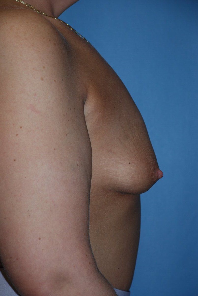Breast Augmentation Patrick Felice Before & After