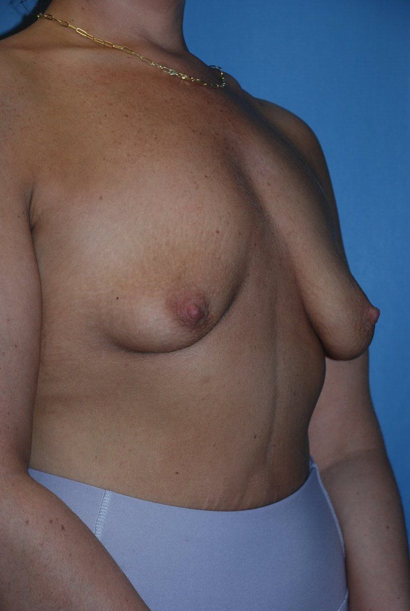 Breast Augmentation Patrick Felice Before & After