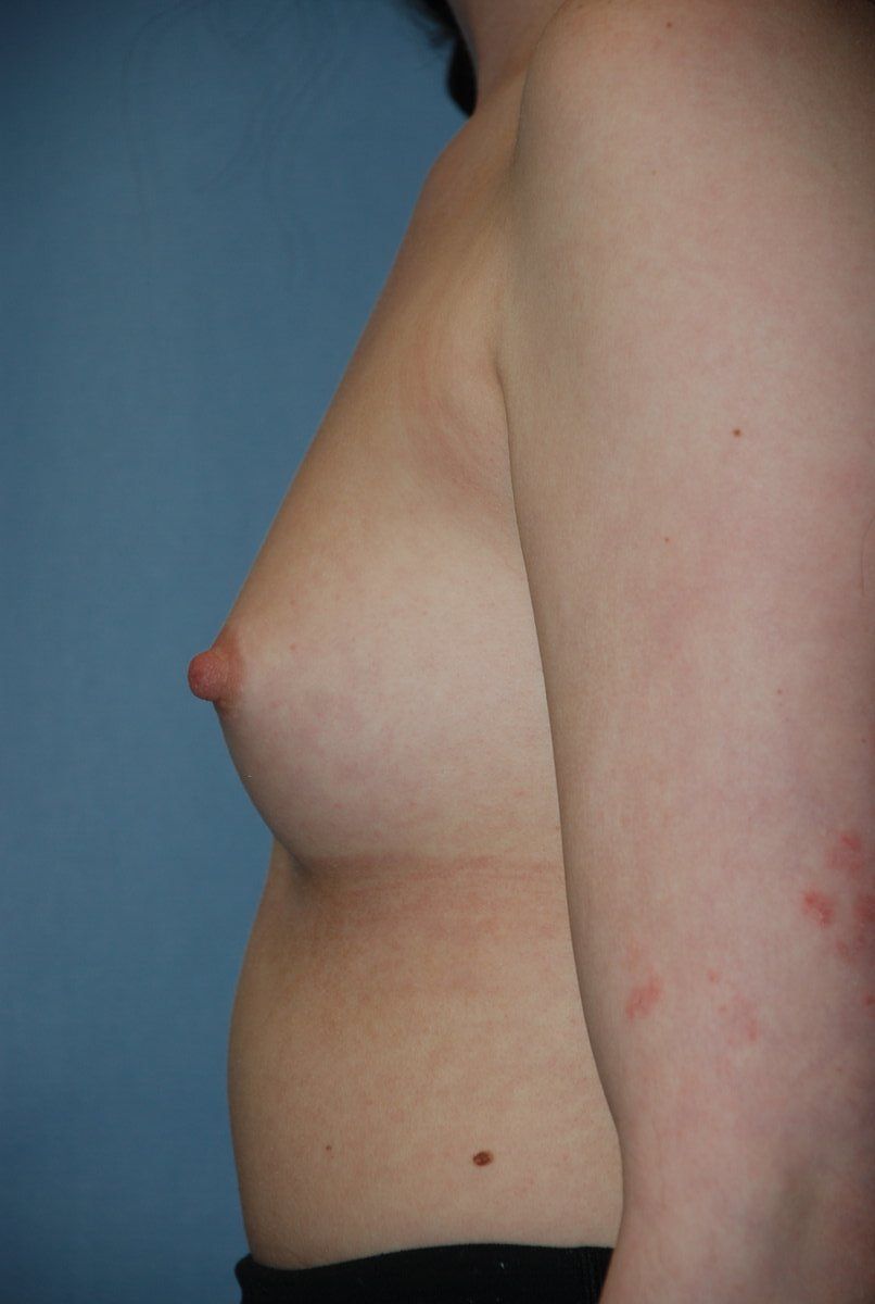 Breast Augmentation Patrick Felice Before & After