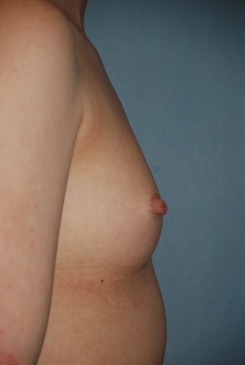 Breast Augmentation Patrick Felice Before & After