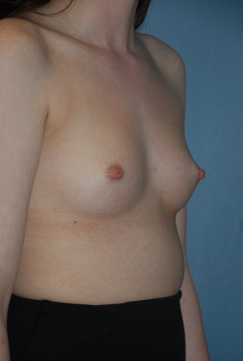 Breast Augmentation Patrick Felice Before & After