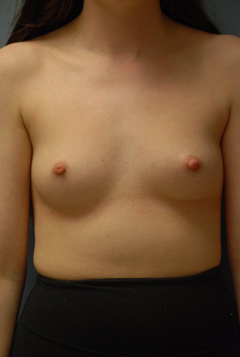 Breast Augmentation Patrick Felice Before & After