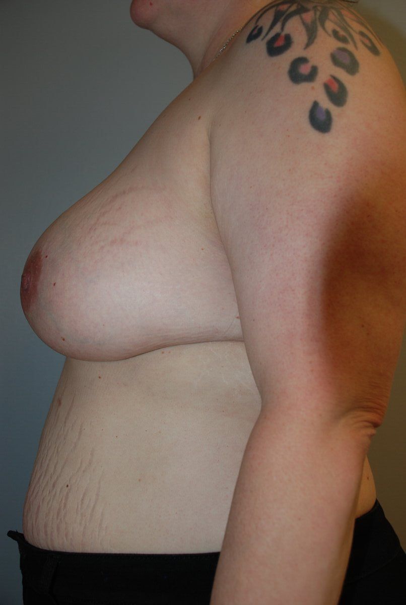 Breast Augmentation Patrick Felice Before & After