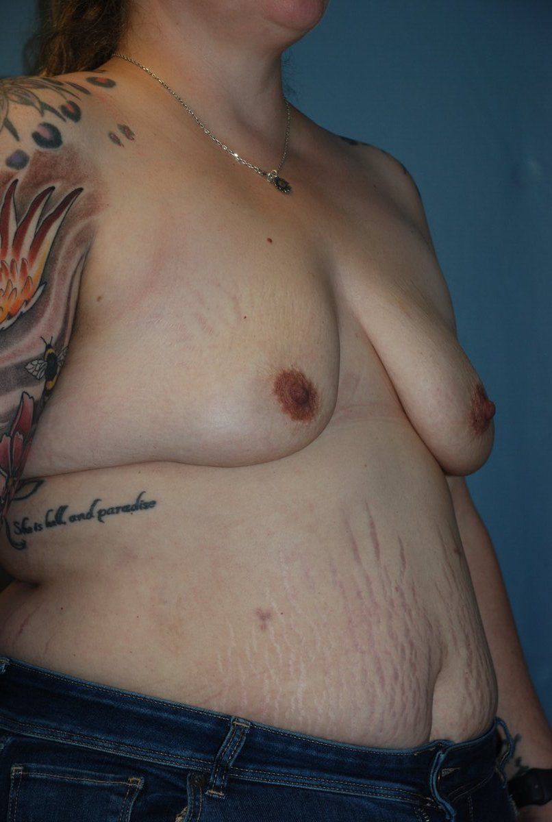 Breast Augmentation Patrick Felice Before & After