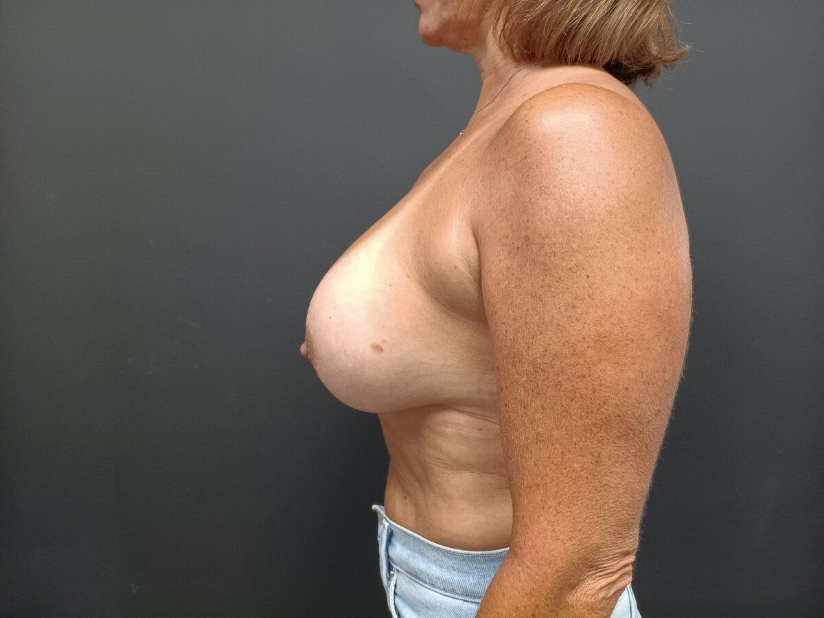 Breast Augmentation Patrick Felice Before & After