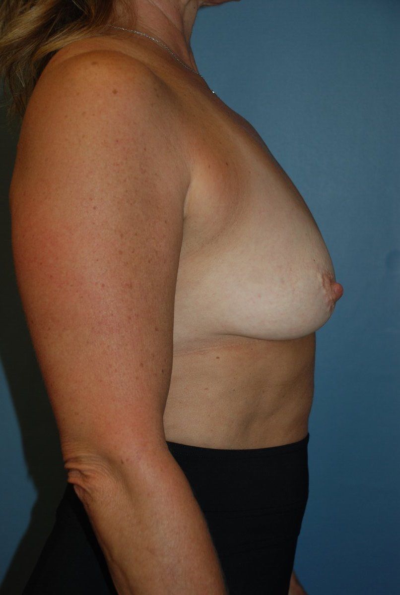 Breast Augmentation Patrick Felice Before & After