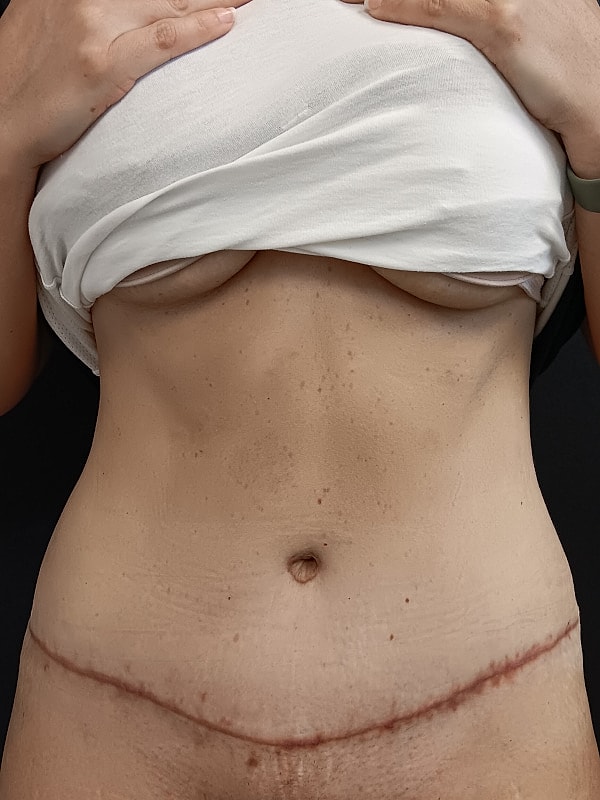 Abdominoplasty Patrick Felice Before & After