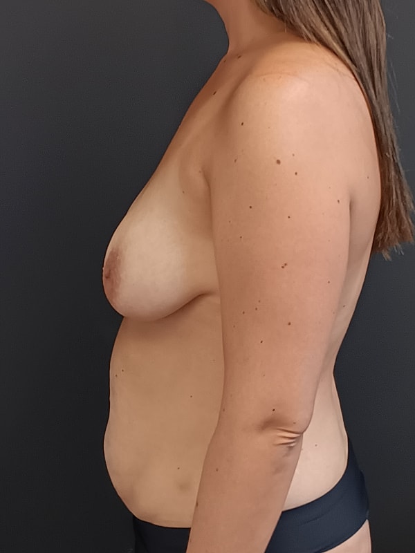Abdominoplasty Patrick Felice Before & After