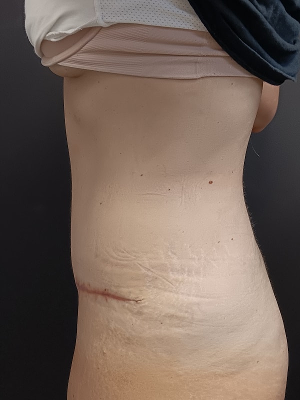 Abdominoplasty Patrick Felice Before & After