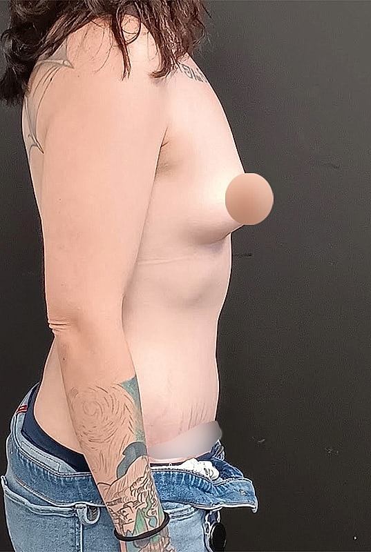 Abdominoplasty Patrick Felice Before & After
