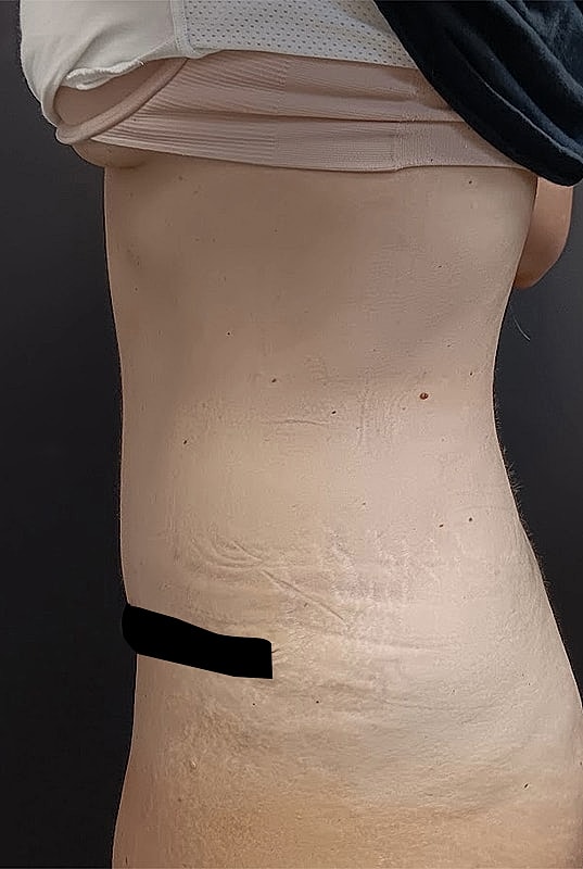 Abdominoplasty Patrick Felice Before & After