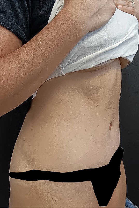Abdominoplasty Patrick Felice Before & After