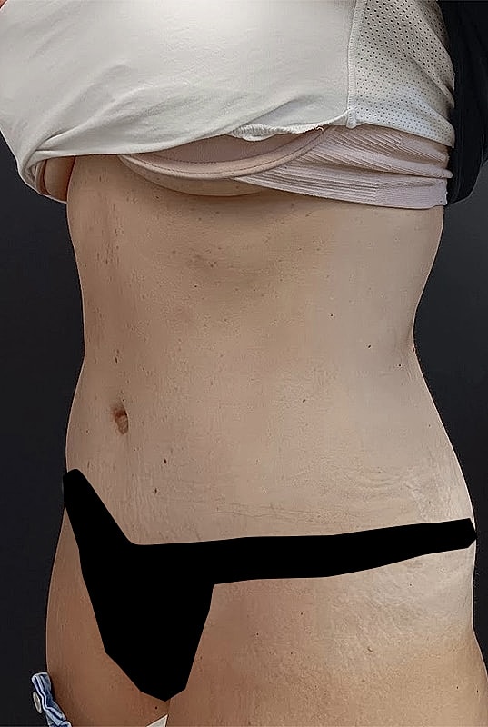 Abdominoplasty Patrick Felice Before & After