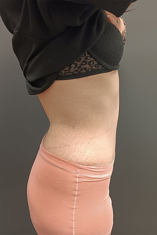 Abdominoplasty Patrick Felice Before & After