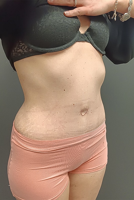 Abdominoplasty Patrick Felice Before & After