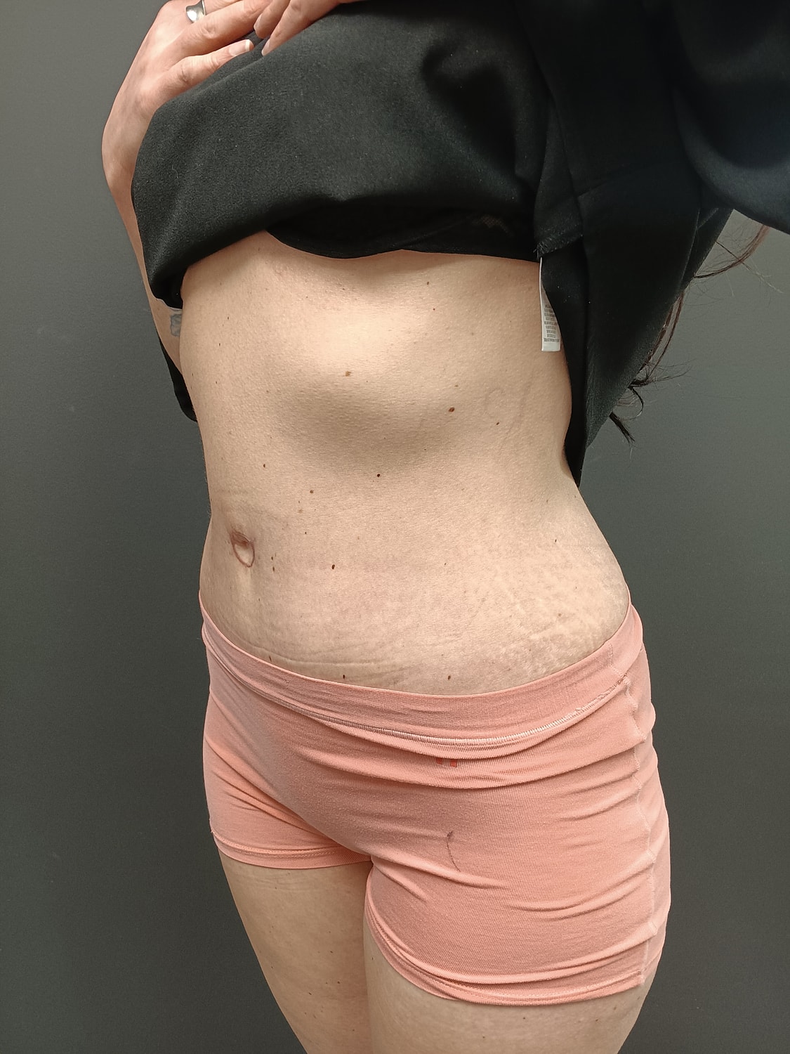 Abdominoplasty Patrick Felice Before & After