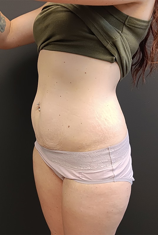 Abdominoplasty Patrick Felice Before & After