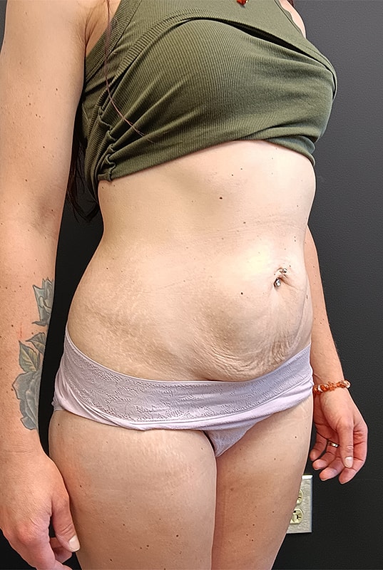 Abdominoplasty Patrick Felice Before & After