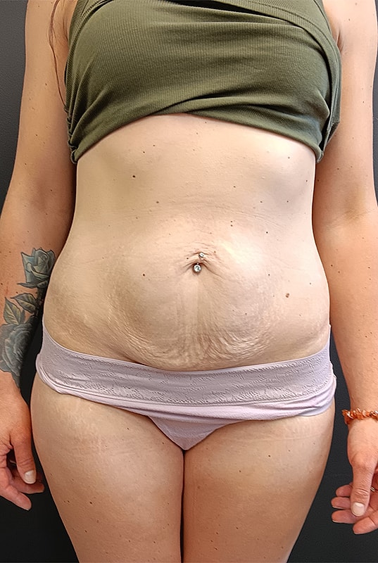 Abdominoplasty Patrick Felice Before & After