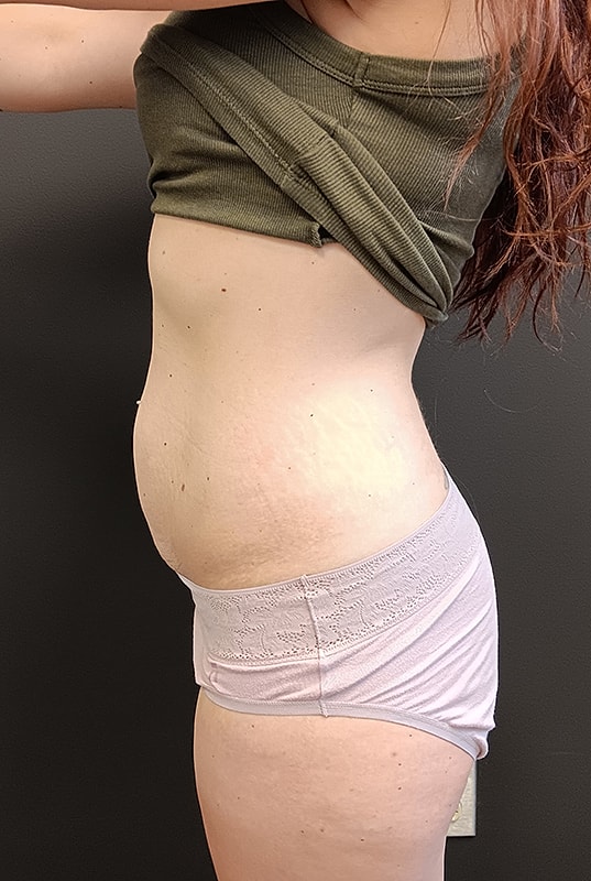 Abdominoplasty Patrick Felice Before & After