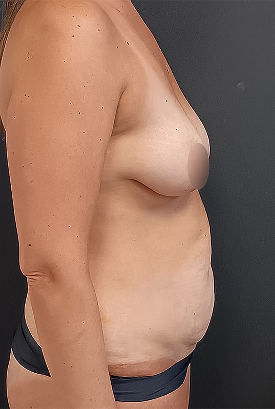 Abdominoplasty Patrick Felice Before & After