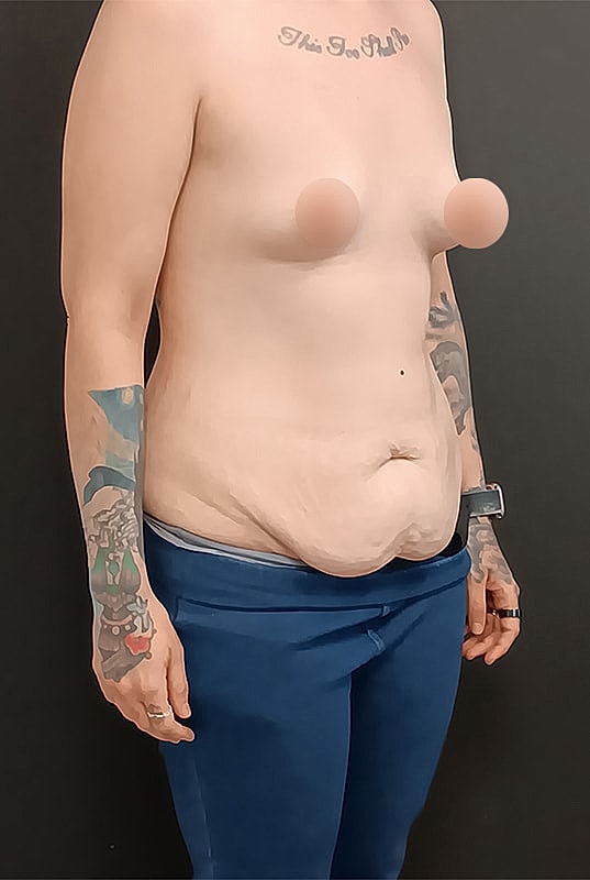 Abdominoplasty Patrick Felice Before & After