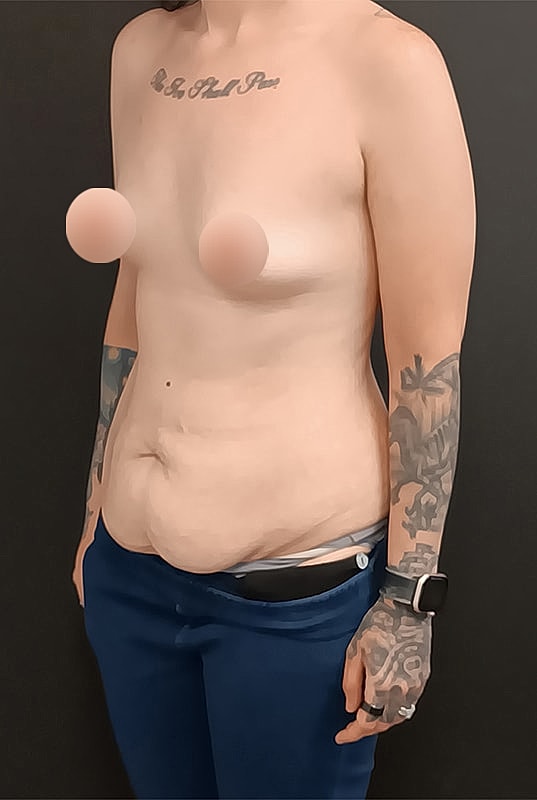 Abdominoplasty Patrick Felice Before & After