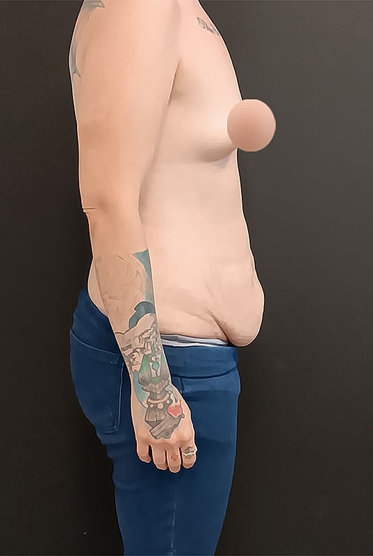 Abdominoplasty Patrick Felice Before & After
