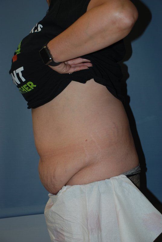 Abdominoplasty Patrick Felice Before & After