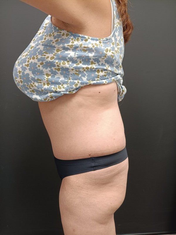 Abdominoplasty Patrick Felice Before & After