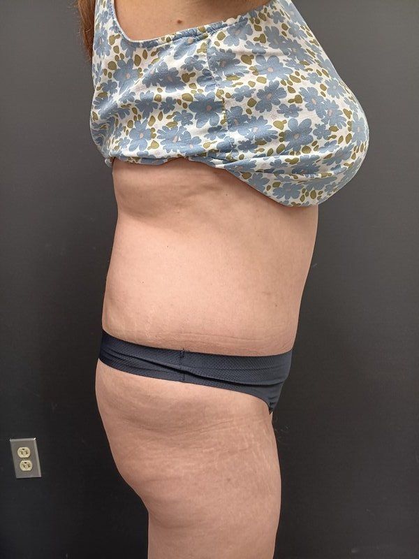 Abdominoplasty Patrick Felice Before & After