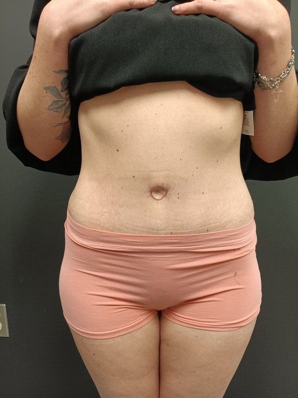 Abdominoplasty Patrick Felice Before & After