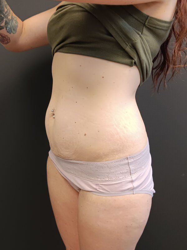 Abdominoplasty Patrick Felice Before & After