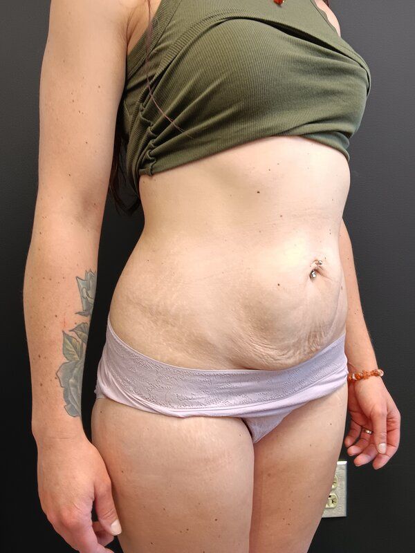 Abdominoplasty Patrick Felice Before & After