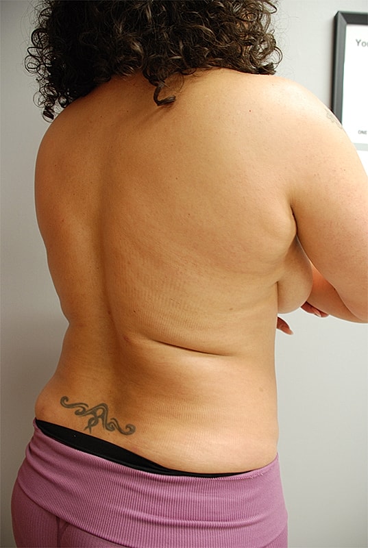 Liposuction Patrick Felice Before & After