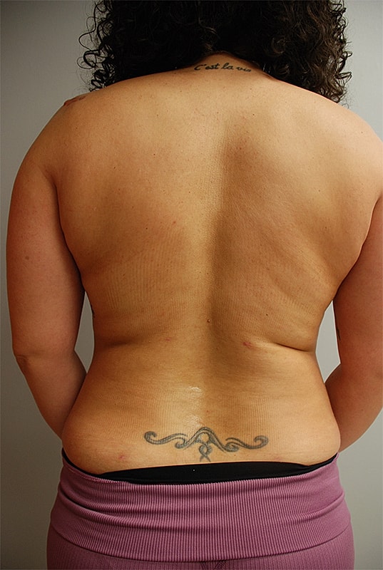 Liposuction Patrick Felice Before & After