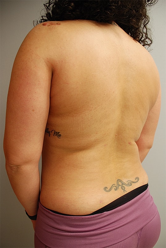 Liposuction Patrick Felice Before & After