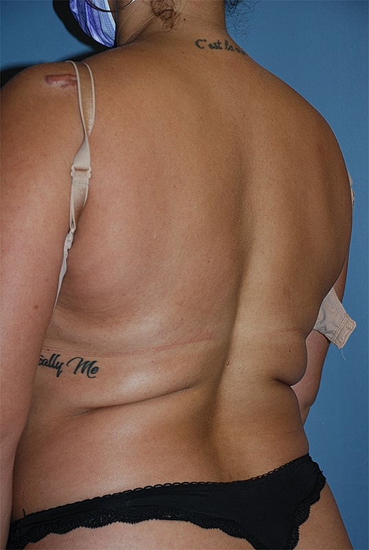 Liposuction Patrick Felice Before & After