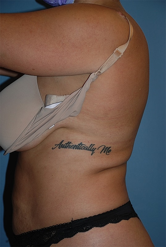 Liposuction Patrick Felice Before & After