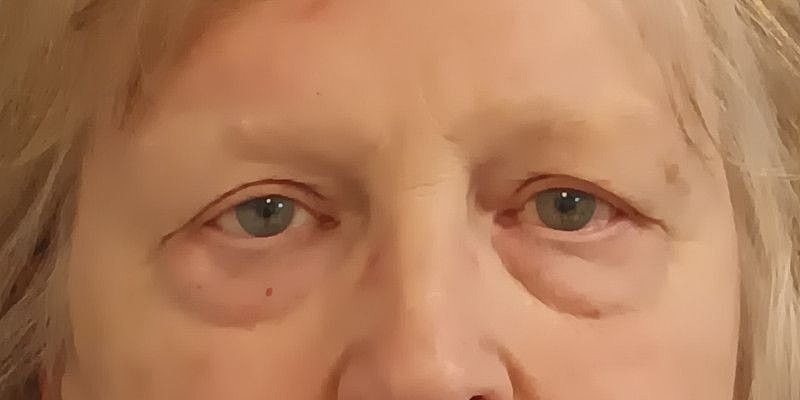 Eyelid Surgery Patrick Felice Before & After