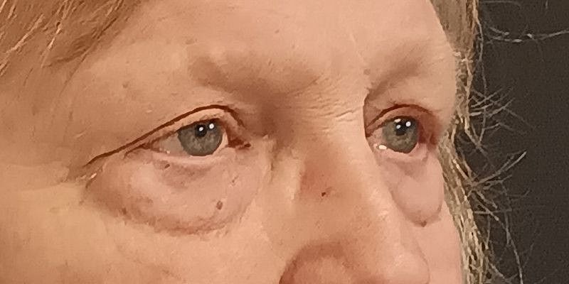 Eyelid Surgery Patrick Felice Before & After